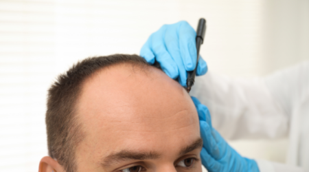 haarimplantatie in Amsterdam